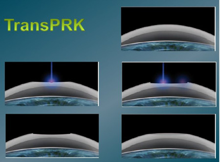 TransPRK与宇航飞秒激光近视手术哪个好