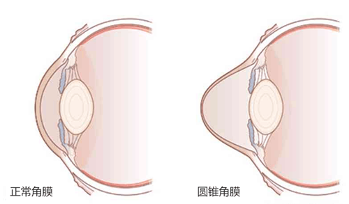 武汉市红十字会普瑞眼角膜库两位角膜患者重塑光明