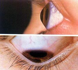 武汉市红十字会普瑞眼角膜库两位角膜患者重塑光明