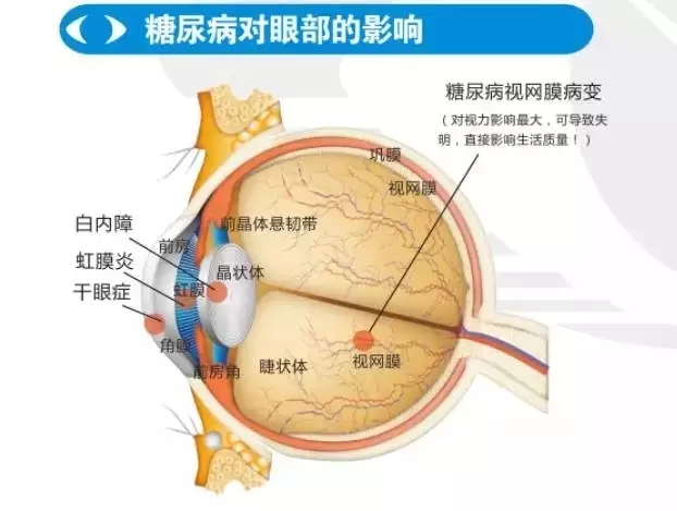 【联合国糖尿病日】关注糖尿病眼病，让“视界”亮起来!