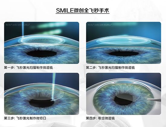 武汉普瑞眼科医院 全飞秒近视手术过程