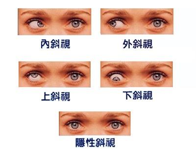 斜视的方法有哪些？能吗？