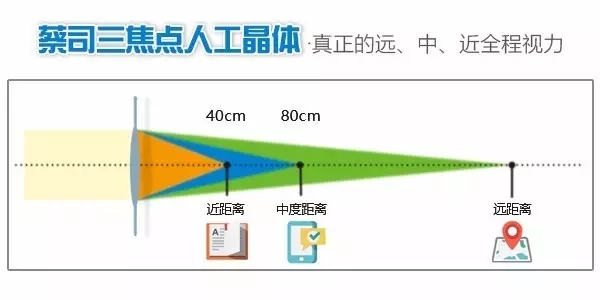 三焦点晶体植入让视力重返年轻态