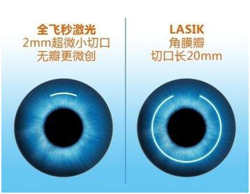 激光矫正近视手术主要有哪几种?