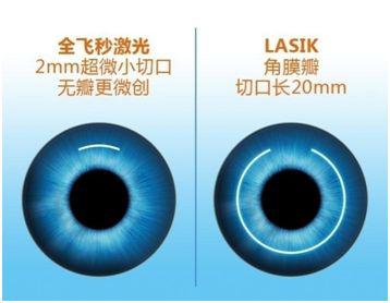 近视眼激光手术