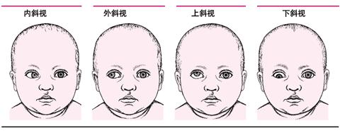 斜视手术后多久可以恢复？手术要休息多久？