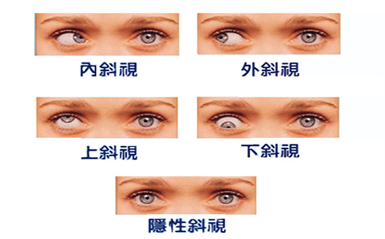 什么是内斜视？发现内斜视怎么矫正？