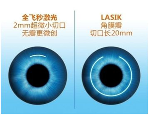 全激光近视手术：原来你离一个清晰美丽的世界仅需15分钟