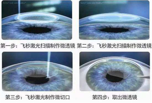 全激光近视手术：原来你离一个清晰美丽的世界仅需15分钟