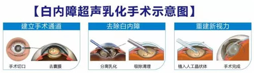 普瑞眼科白内障专家张晓农教授受邀做客《邦华导医》