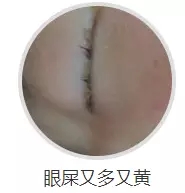 1月2、3日，普瑞眼科医院泪道专家来汉亲诊，预约请速