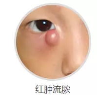 1月2、3日，普瑞眼科医院泪道专家来汉亲诊，预约请速