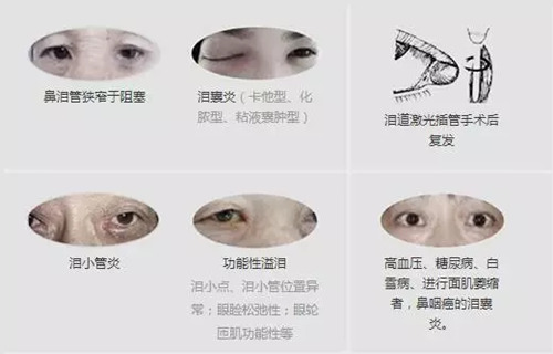 1月2、3日，普瑞眼科医院泪道专家来汉亲诊，预约请速