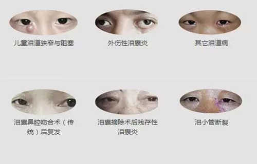 1月2、3日，普瑞眼科医院泪道专家来汉亲诊，预约请速