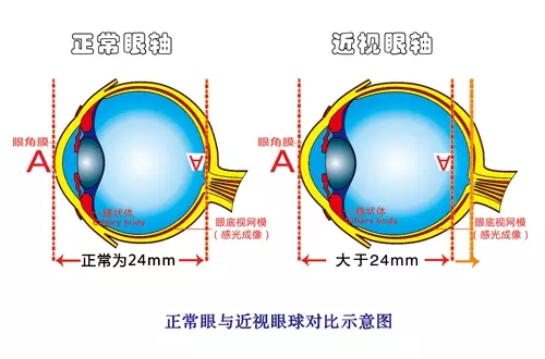 开学季：孩子近视度数涨到600度，只因爸妈说了这六句话!