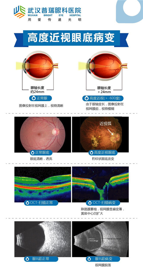 取下眼镜寸步难行 武汉2600度近视女孩普瑞眼科重获清晰视界