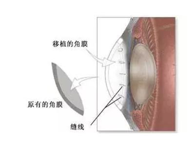 普瑞眼科角膜移植手术25000元左右/单眼，一周内手术