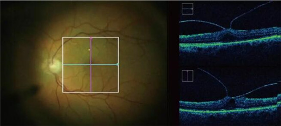 术中OCT导航显微镜ZEISS RESCAN700即将落户武汉普瑞眼科医院