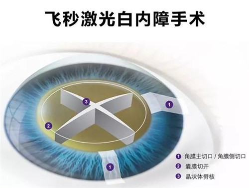 60年技术革新，无刀铂晶飞秒白内障手术时代来临