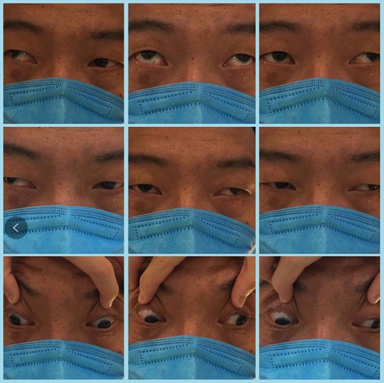 斜视遇上眼球震颤，30岁男子在普瑞眼科解决顽疾重拾自信