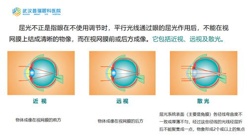 远视怎么?千频优视飞秒手术助远视大学生恢 复视力