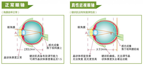 武汉普瑞眼科王晓亚医生：正确看待近视问题早发现早防控