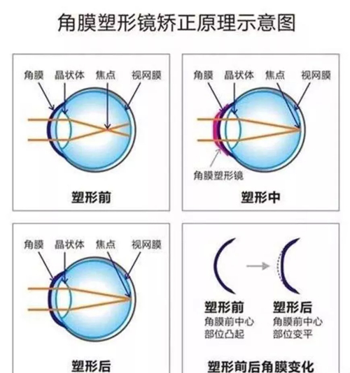武汉普瑞眼科王晓亚医生：正确看待近视问题早发现早防控