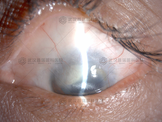 角膜白斑能吗?角膜白斑女子在武汉普瑞眼科重获光明