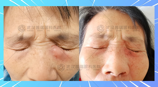 婆婆眼起脓包原是泪道堵塞 普瑞眼科为其解顽疾疏通泪道