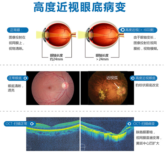 精 准icl晶体植入助力超高度近视女孩摘镜圆梦