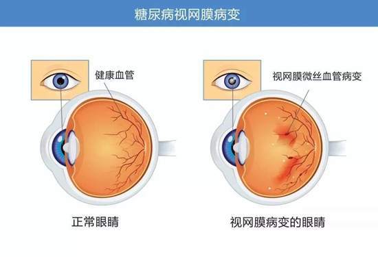 武汉糖尿病视网膜病变能治 愈吗?普瑞眼科许泽骏院长讲解