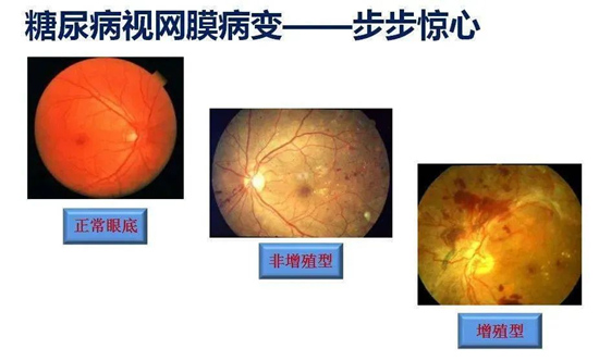 武汉糖尿病视网膜病变能治 愈吗?普瑞眼科许泽骏院长讲解