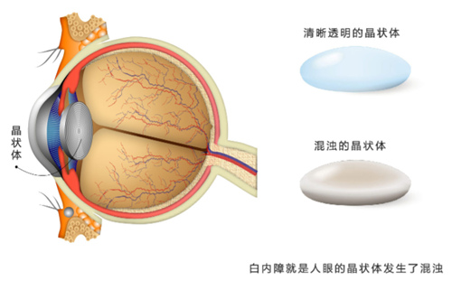 武汉糖尿病视网膜病变哪家好？糖网白内障怎么？