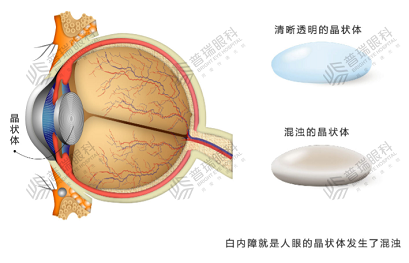 专家提醒：白内障手术一定要及时做！