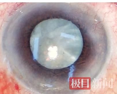 程旭康院长为八旬老人实施双眼手术