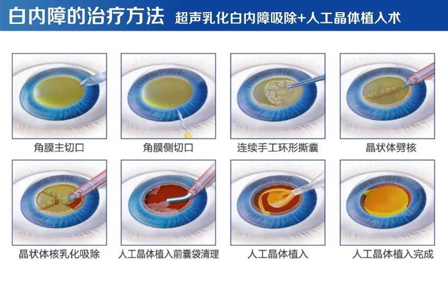 如何白内障？人工晶体怎选？武汉普瑞眼科医院来介绍