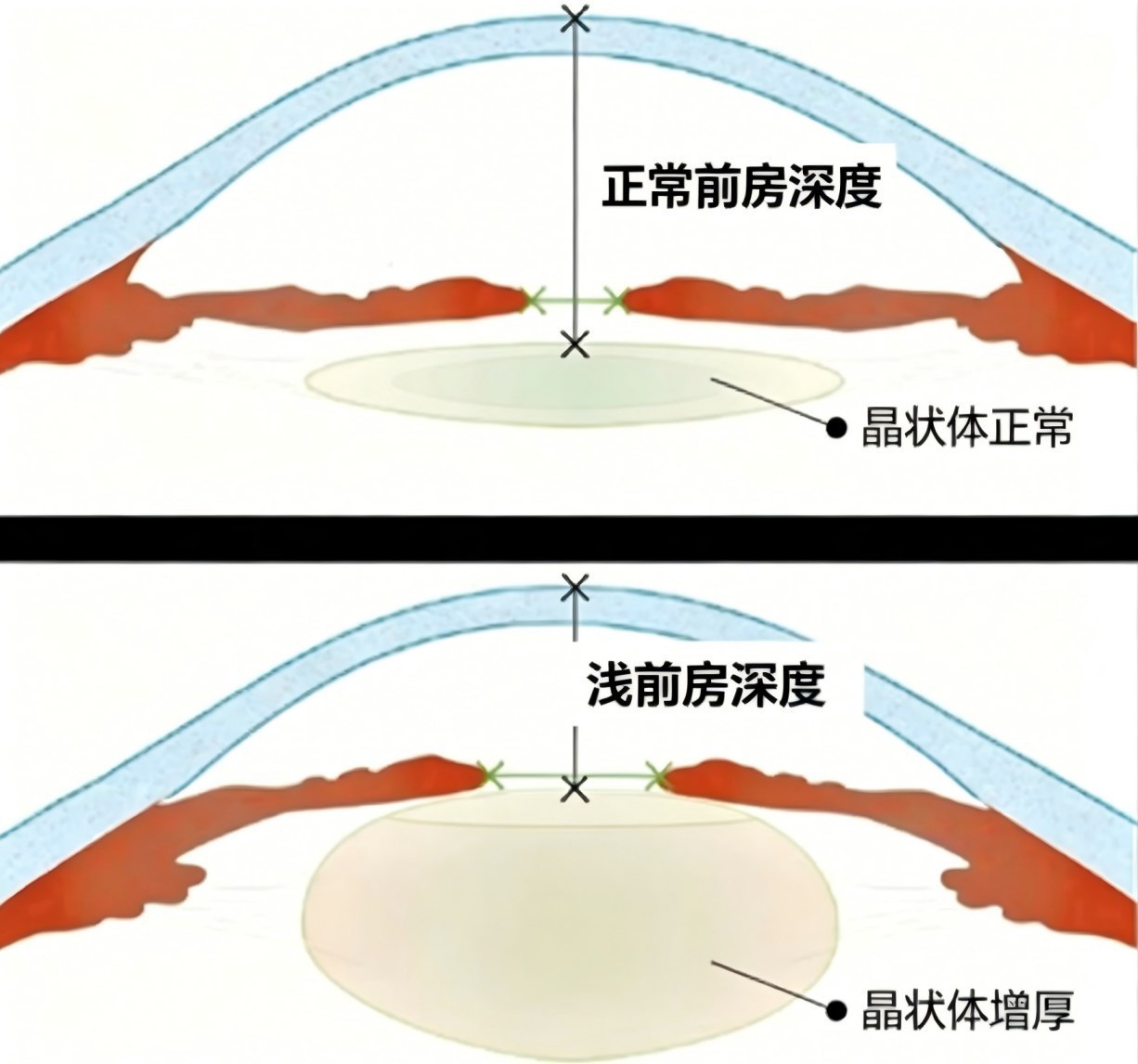 婆婆白内障拖至急性青光眼发作 武汉普瑞阮丽娟完成手术